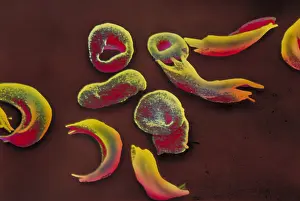 Cytopathology Prints: SCD, Sickle-Cell Anemia, under a microscope (SEM)