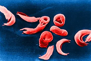 Cytopathology Prints: SCD, Sickle-Cell Anemia, under a microscope (SEM)