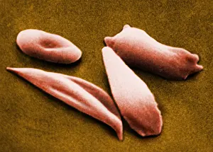 Cytopathology Prints: SCD, Sickle-Cell Anemia, under a microscope (SEM)