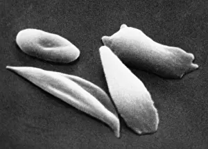 Molecules Prints: SCD, Sickle-Cell Anemia, under a microscope (SEM)