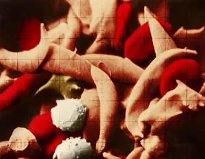 Cytopathology Prints: SCD, Sickle-Cell Anemia, under a microscope (SEM)