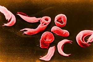 Cytopathology Prints: SCD, Sickle-Cell Anemia, under a microscope (SEM)