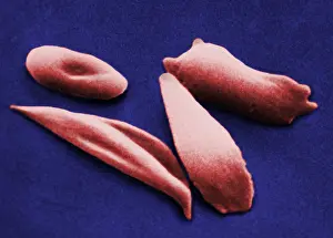 Histopathology Prints: SCD, Sickle-Cell Anemia, under a microscope (SEM)