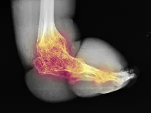 Density Prints: Severe Bone Degeneration in 63 Year Old Paraplegic