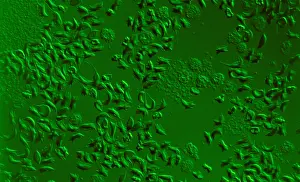 Sickle Cell Prints: Sickle Cell Anemia