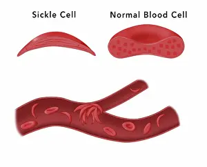 Recessive Prints: Sickle cell anemia disease, a normal blood cell