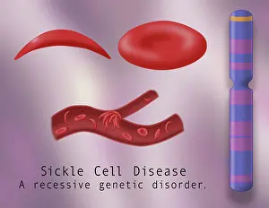 Mutation Prints: Sickle cell anemia disease, a normal blood cell