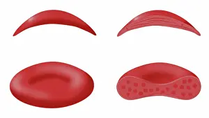 Mutation Prints: Sickle cell anemia disease, a normal blood cell, a sickle shaped blood cell, illustration