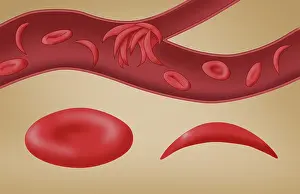 Mutation Prints: Sickle cell anemia disease, a normal blood cell