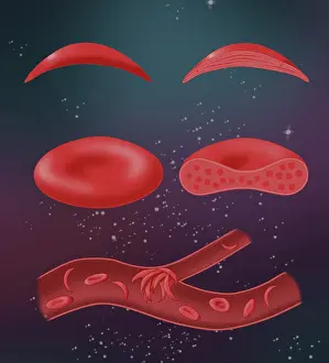 Mutation Prints: Sickle cell anemia disease, a normal blood cell