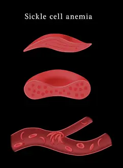 Mutation Prints: Sickle cell anemia disease, a normal blood cell