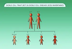 Trait Prints: Sickle Cell Trait (SCT) and Sickle Cell Anemia Disease (SCD) genetic inheritance chart