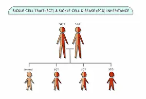Trait Prints: Sickle Cell Trait (SCT) and Sickle Cell Anemia Disease (SCD) genetic inheritance chart