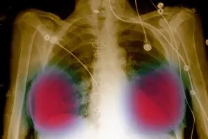 Radiographs Prints: Silicone breast implants