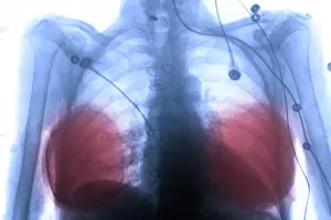 Radiographs Prints: Silicone breast implants