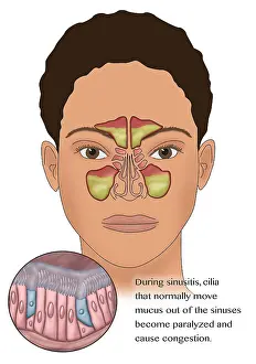 Sinus Anatomy During a Sinus Infection, Medical Illustration