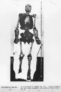 1936 Prints: Skeletal Reconstruction, Buck Ruxton Murder