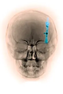 Radiographs Prints: Skull x-ray of a shunt in the brain ventricle
