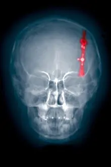 Radiographs Prints: Skull x-ray of a shunt in the brain ventricle