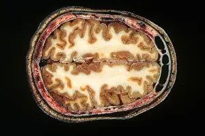Specimen Prints: Slice of Human Brain, gross specimen