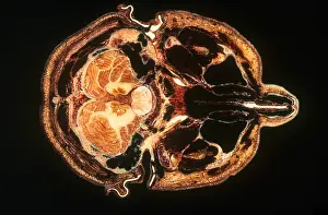 Specimen Prints: Slice of Human Brain, gross specimen
