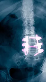 Back Prints: Spinal Fusion