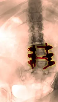 Back Prints: Spinal Fusion