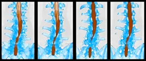Back Prints: Spine, CT Scan