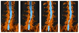 Back Prints: Spine, CT Scan