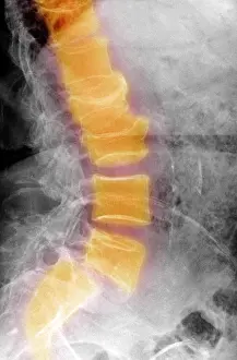 Spinal Prints: Spondylolisthesis