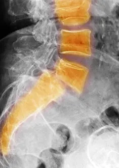 Spinal Prints: Spondylolisthesis