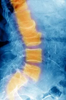 Spinal Prints: Spondylolisthesis