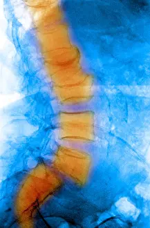 Spinal Prints: Spondylolisthesis