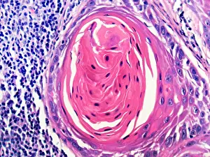 Pathological Prints: Squamous Cell Carcinoma, Keratin Pearl, light micrograph