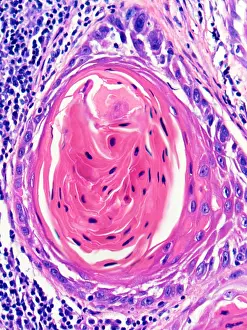 Pathological Prints: Squamous Cell Carcinoma, Keratin Pearl, light micrograph