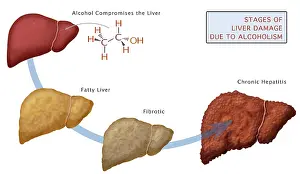 Damage Prints: Stages of Liver Damage