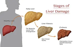 Damage Prints: Stages of Liver Damage