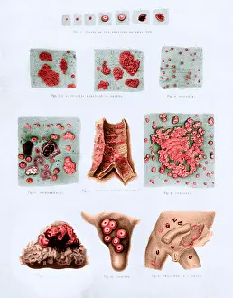 Major Prints: Stages and Types of Smallpox