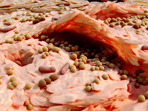 Microorganisms Prints: Staphylococcus aureus bacteria on the cracked skin of a neurodermatitis patient