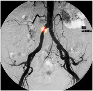Diagnosis Prints: Stenosis in Common Iliac Artery (1 of 2)