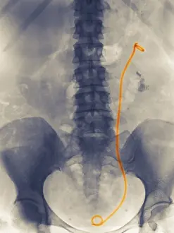 Stone Prints: Stent from Kidney to Bladder