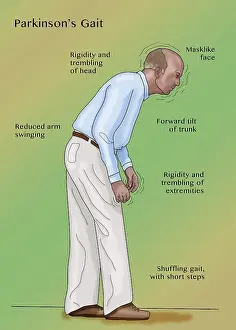 Pathological Prints: The stooped, shuffling gait of Parkinson's disease (PD)