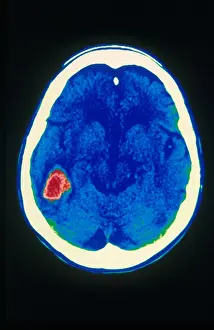 Computed Prints: Stroke, CT Scan