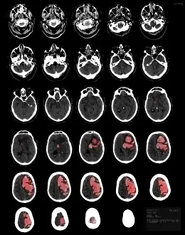 Year Prints: Stroke Montage, 82 year old man