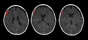 Child Prints: Subdural Hematoma in 6 Month Old, CT Scan
