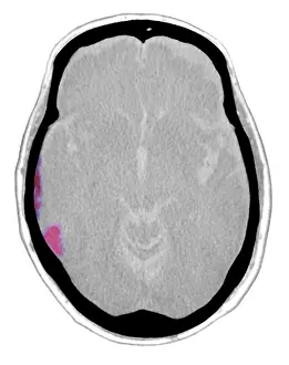 Diagnosis Prints: Subdural Hematoma, CT Scan