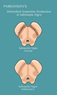 Neurological Prints: The substantia nigra region of the brain in Parkinson's disease has diminished dopamine transmission in neurons