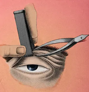 Medical Prints: Surgery to Correct Lazy Eyelid, 1830