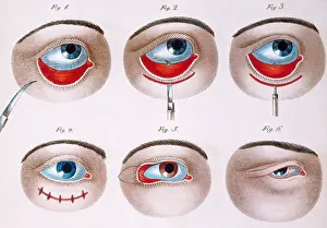 Operating Prints: Surgery to Correct Ptosis, 1830