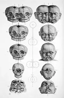 Twins Prints: Surgical Anatomy, 1856